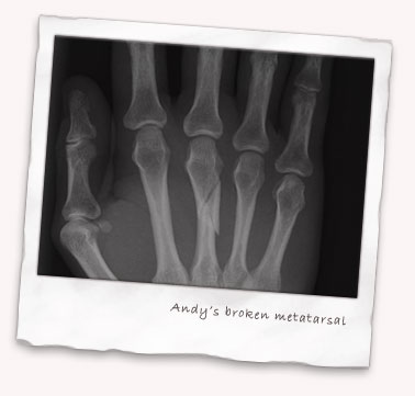 Andys broken metatarsal in his hand